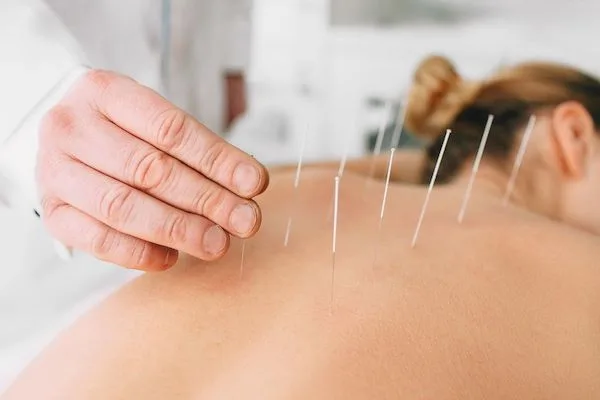 Acupuncture