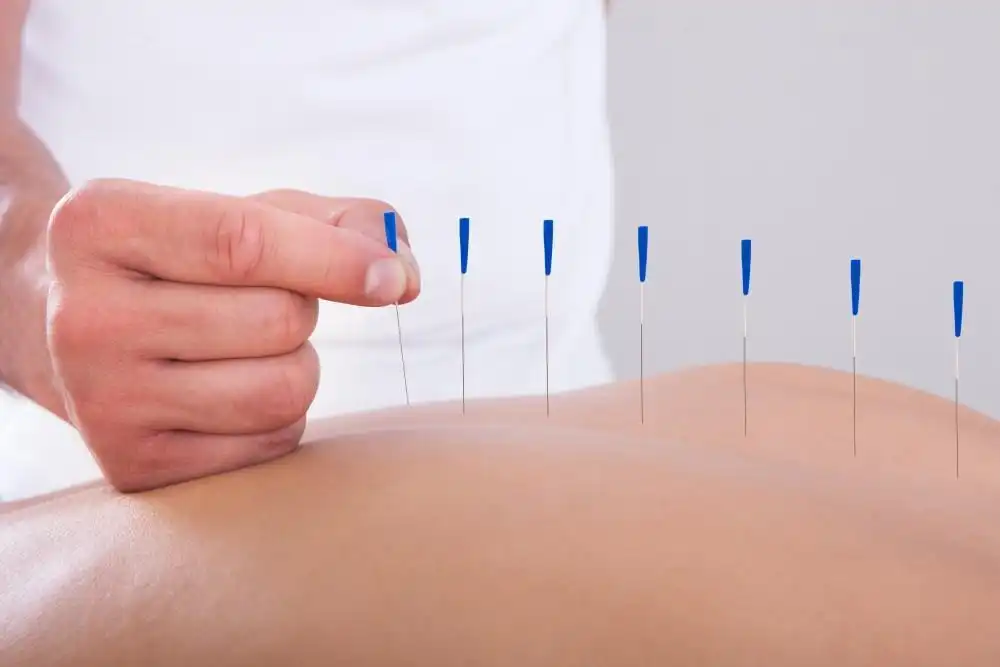 Holiday Stress? Discover Natural Pain Relief with Acupuncture and Chiropractic Care